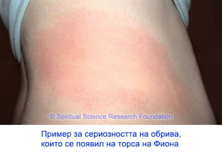 2-BG-skin-rash-treatment-torso