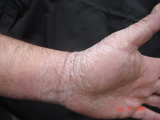 Eczema en las manos curada con tratamiento espiritual