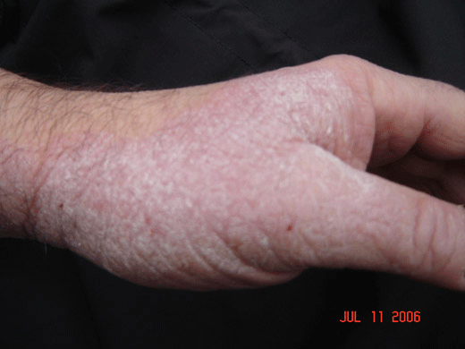 Eczema en las manos curada con tratamiento espiritual