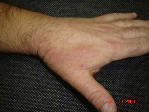 eczema-treatment-2