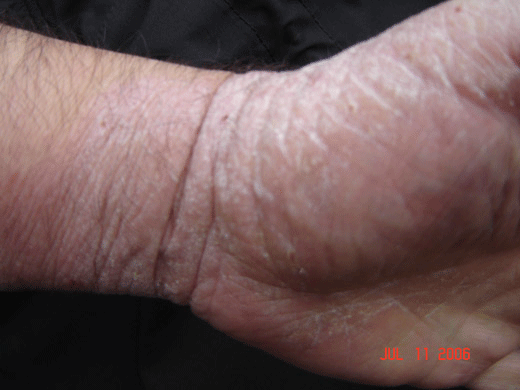 hand-eczema-3
