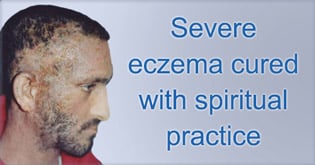 Severe eczema cured with spiritual practice